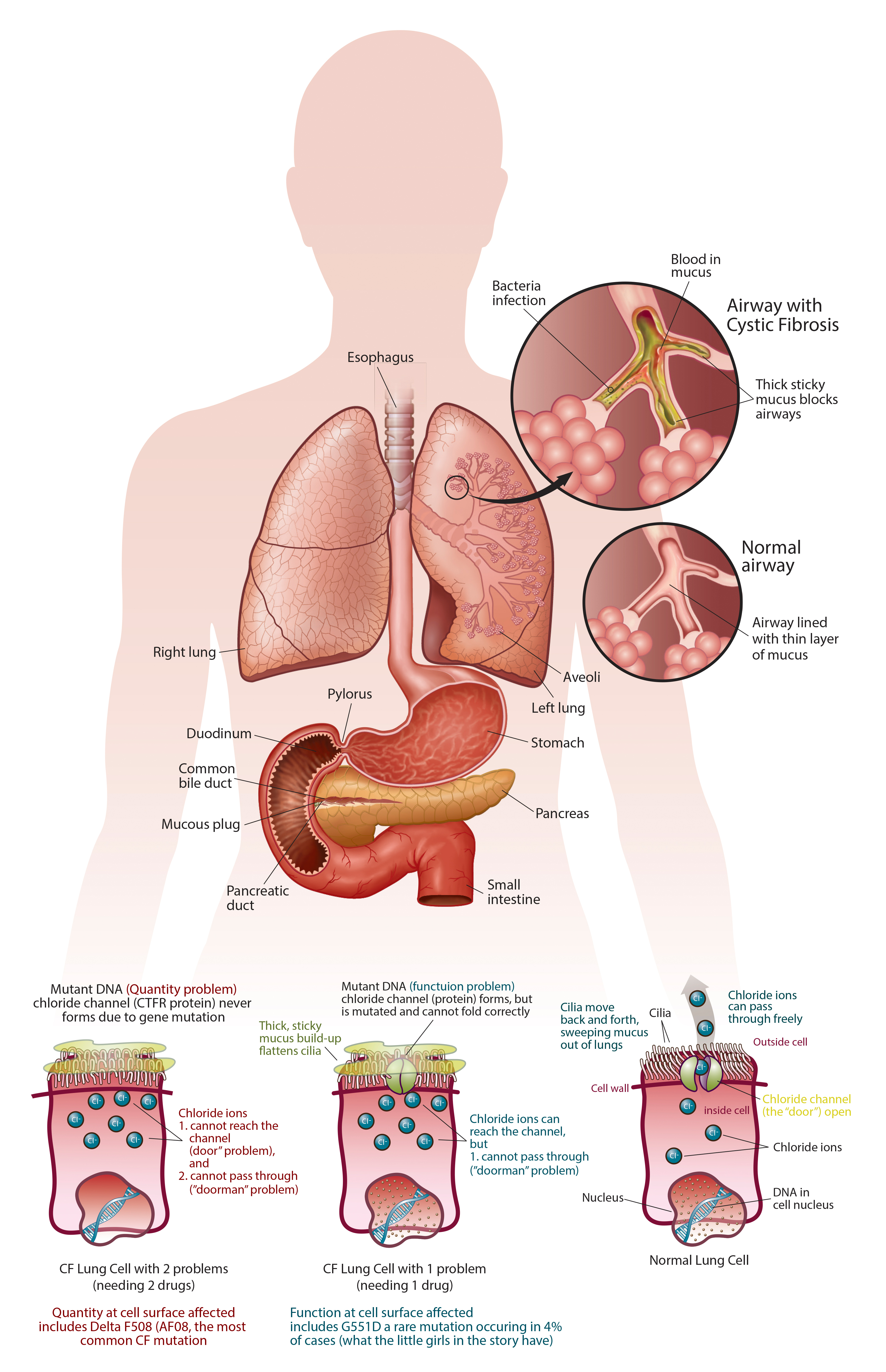 This was illustrated to accompany an feature article about finding a cure for cystic fibrosis.