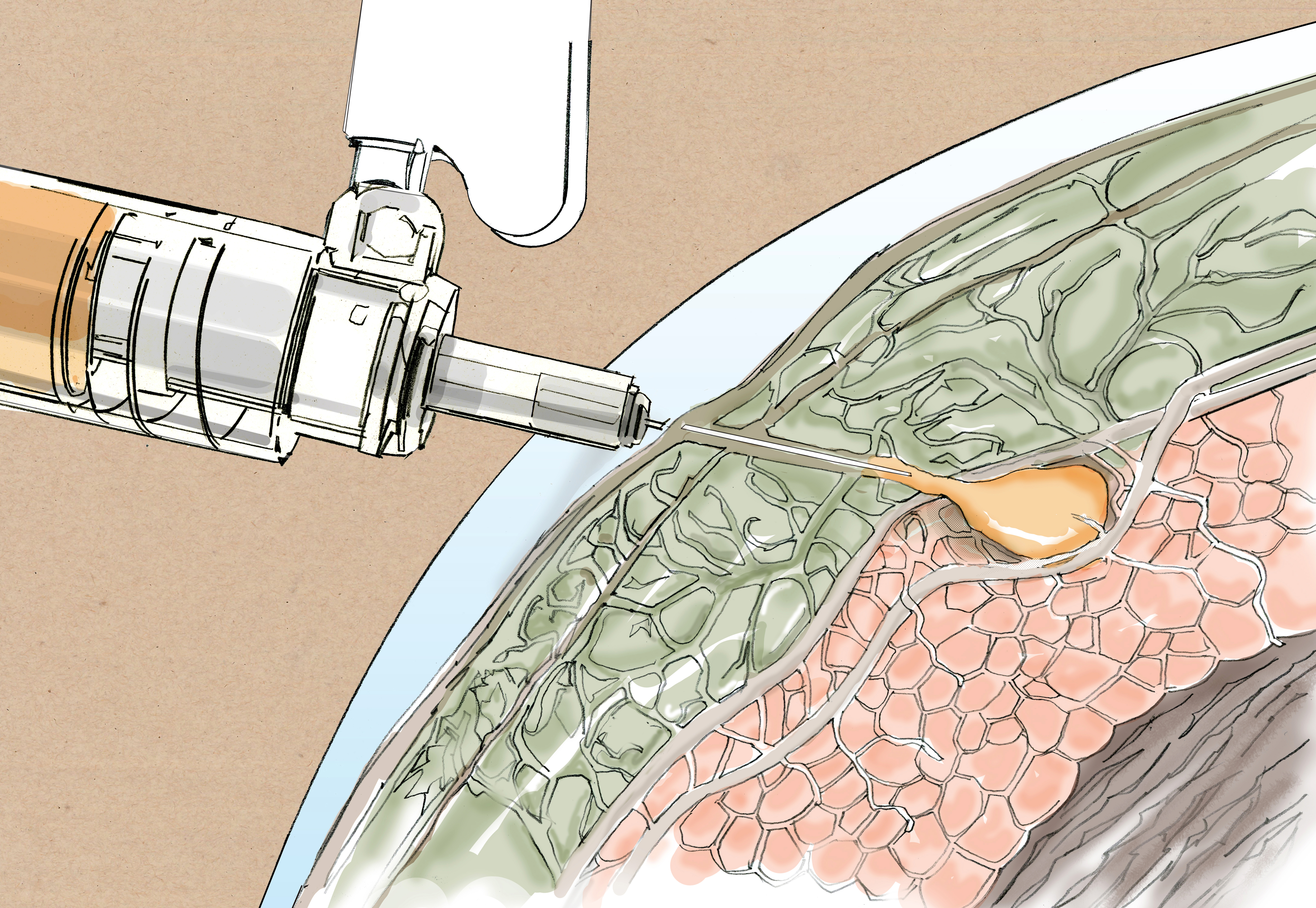 Injection  through layers. Drawn in pencil, watercolor and Photoshop. medical illustration