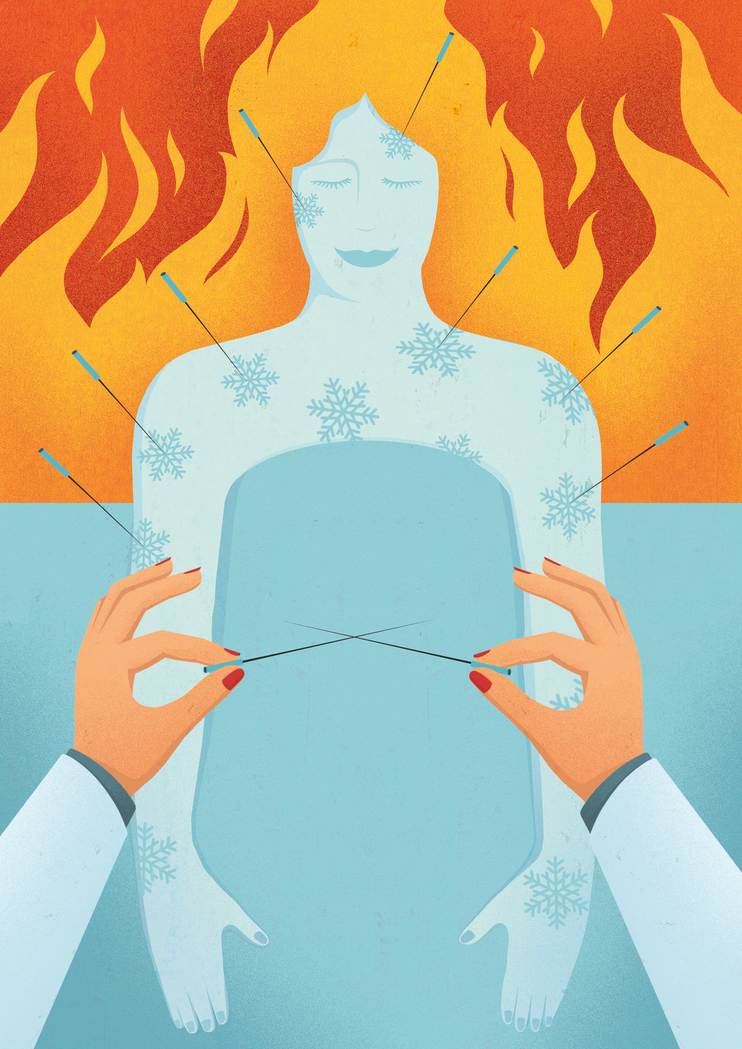 Acupuncture