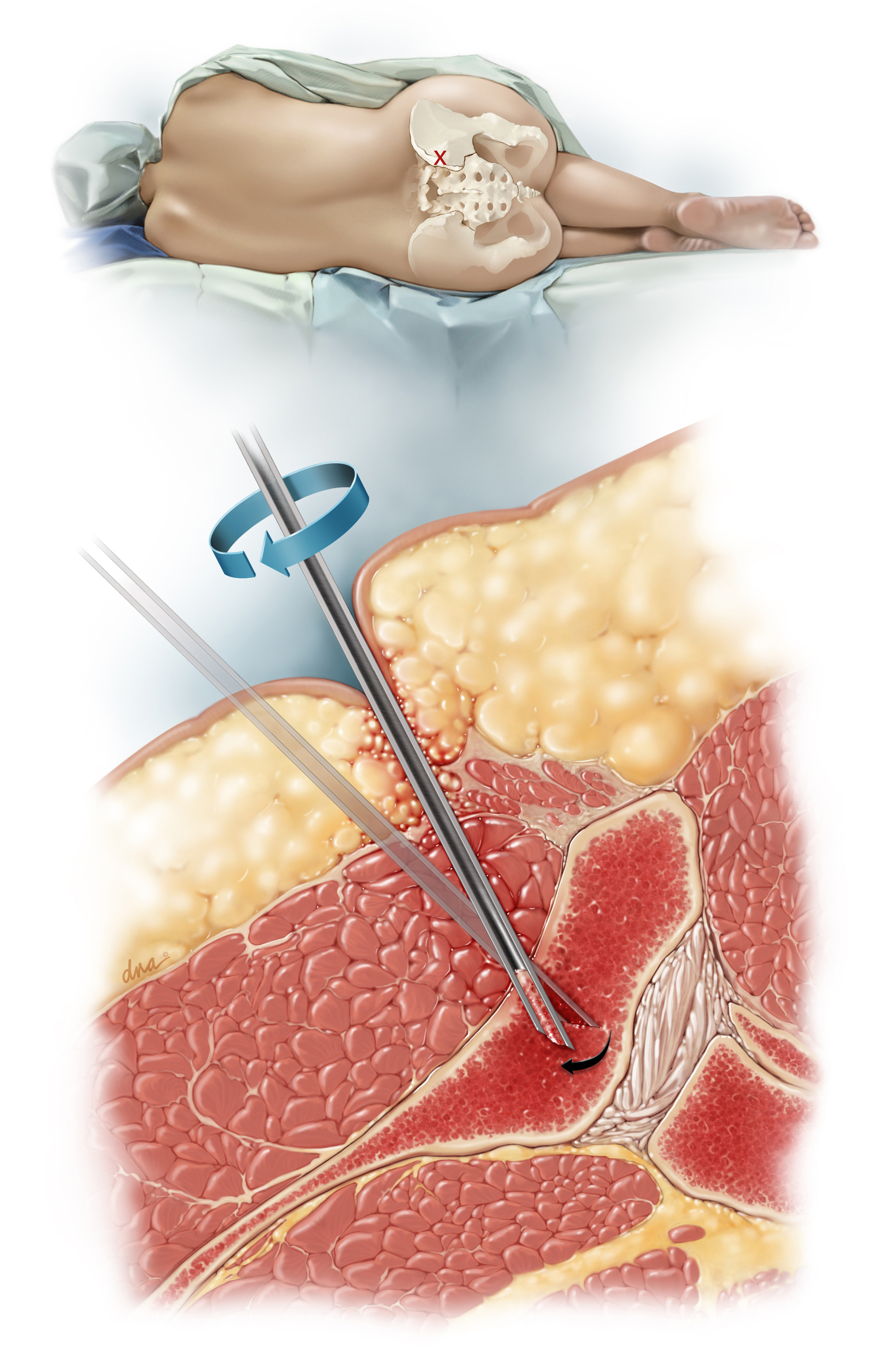 Main illustration shows marrow punch inserted into postertior superior iliac spine (PSIS) to collect biopsy sample. Inset illustration shows patient positioning.