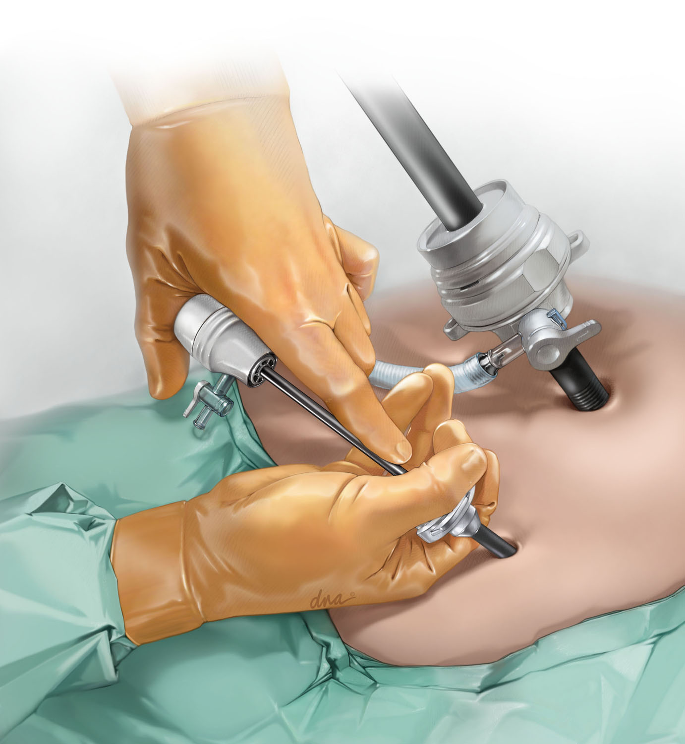 Medical illustration showing insertion of 3 mm mini trochar next to previously placed 5-12 mm versa port in umbilicus. Abdomen is insufflated and draped for pelvic surgery.