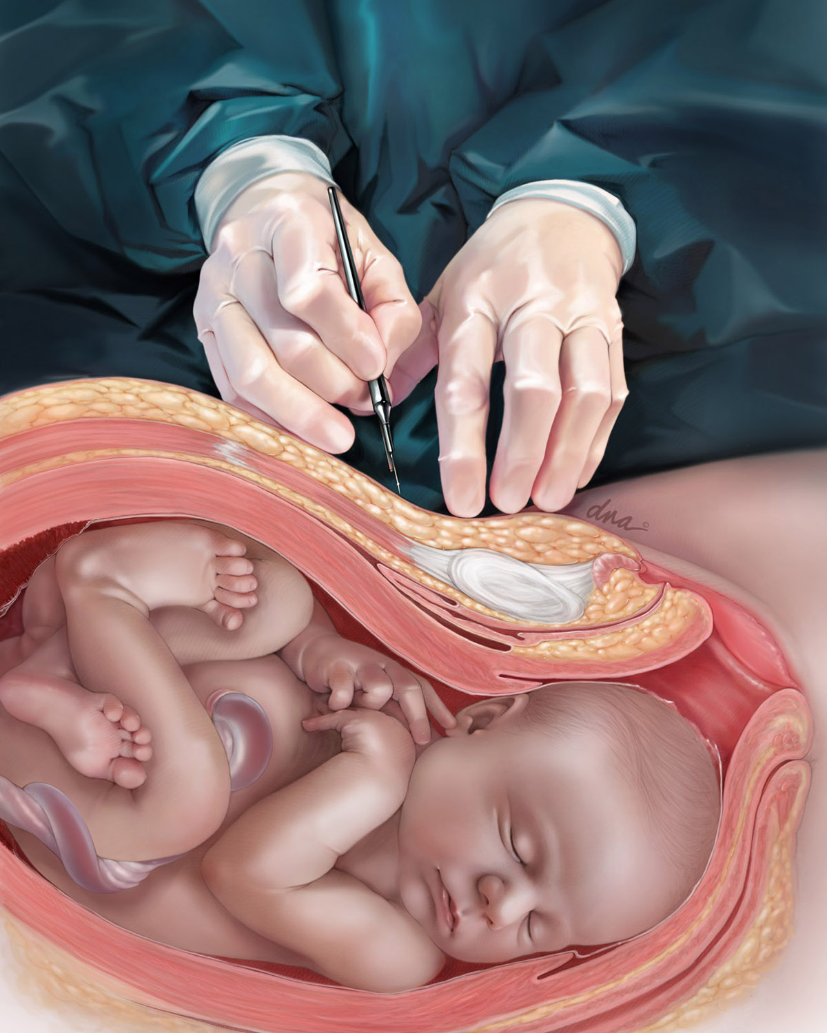 Surgeon about to preform a cesarean section. Patient is shown in cross section, stalled in early phase two labor.