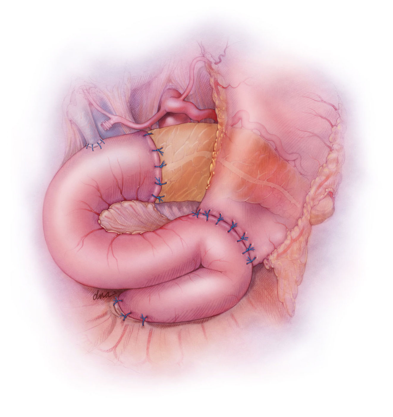 The Whipple Procedure